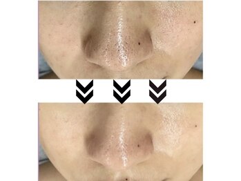 ハピエスト 御坊店/毛穴洗浄