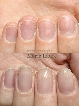 マリーロール 淀屋橋本店(Marie Laure)/自爪育成/深爪矯正/ネイルケア
