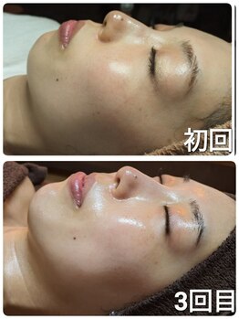 ウララ(ulala)/ララピール初回/3回目