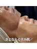 《ハーブピーリング》美白＆シミ予防◎潤う透明感肌コース　９０分