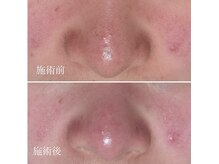 フーサロン(Fuu...salon)の雰囲気（毛穴洗浄をしないと肌トラブルは改善しない！）