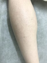 ナノハナ/鹿沼市の全身脱毛のナノハナ