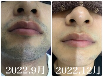 シア 静岡店(cia)/【ヒゲ脱毛】before→after