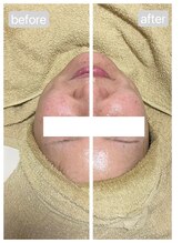 トランク(Trunk)/プラズマフェイシャル♪