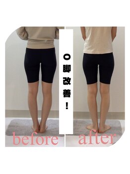 スタイルラボ高松/O脚矯正の効果♪