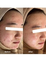 モカ 天王寺店(MOKA)/ホホニキビケアハーブピーリング