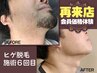 【再来店2回目以降の方/メンズ脱毛】会員価格お試し♪メンズヒゲ脱毛◆¥3,990