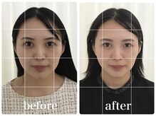 アキュモンド 渋谷院(acumond)/クイック美顔鍼コース3回の変化