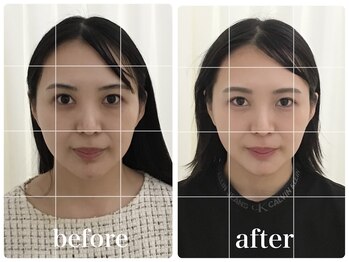 アキュモンド 渋谷院(acumond)/クイック美顔鍼コース3回の変化