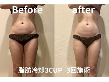 ユー 喜連西店(U)/脂肪冷却【before after】