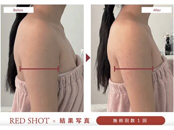 トータルサロン ヴィータ(VITA.)/レッドショット導入でスッキリ♪