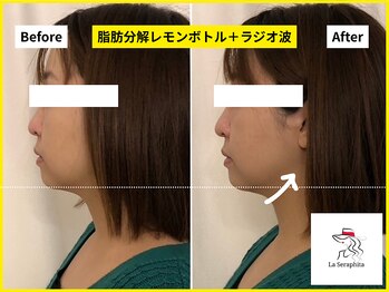 ラ セラフィータ 中目黒/レモンボトル＋ラジオ波