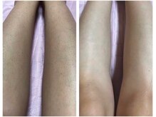 脱毛 痩身ぴゅあら/脱毛　ひざ下(女性)