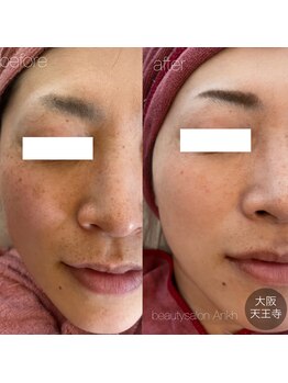 アンク(Ankh)/シミケアで肌質改善も！