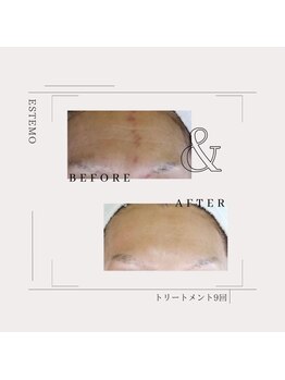 エステモ 札幌店(ESTEMO)/ハーブピーリングBefore&After