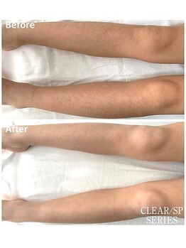 セラス(CERAS)/女性足脱毛