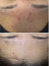 ユマニ バイ ヒート(Humani by HEAT)/しつこい肌荒れにもララピール