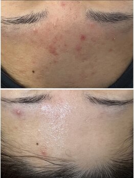 ユマニ バイ ヒート(Humani by HEAT)/しつこい肌荒れにもララピール