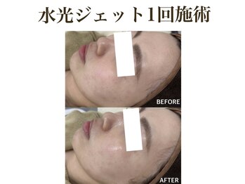 ティアム バイ テトテ 神戸三宮(TIAM by tetote)/水光ジェット