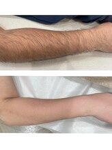 ビアンカ(BIANCA)/石岡市姉妹店HAIKARASAN腕脱毛