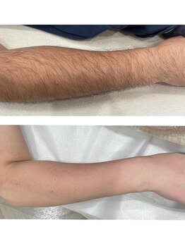 ビアンカ(BIANCA)/石岡市姉妹店HAIKARASAN腕脱毛