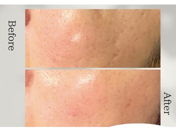 アノネ(Anone.)/プラズマ症例