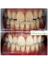 ホワイトニングサロン 広島店/【ホワイトニング20回照射】