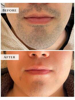 ルアナラウンジ(Luana Lounge)/【症例】 ヒゲ脱毛