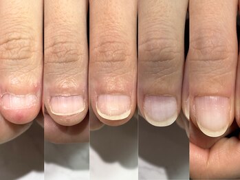 アリエ(allie)/深爪卒業に大切な３ステップ