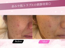 ルーム701(room701)/ニキビ　赤み　くすみ