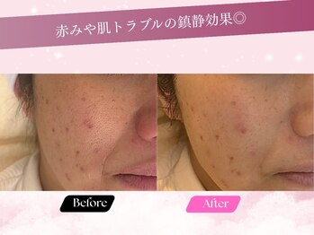 ルーム701(room701)/ニキビ 赤み くすみ