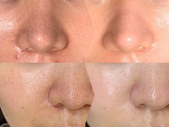 スリースリー 横浜(THREE THREE)の写真/【毛穴をキュッと！】毛穴黒ずみ・毛穴開きも目立たせない◎横浜で人気の肌管理専門エステ｜口コミ高評価