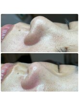 フェリーチェ(felice)/毛穴エクストラクション☆