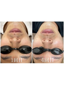 フォルチェ ゆめタウン広島店(Folche)/4回のBefore/After