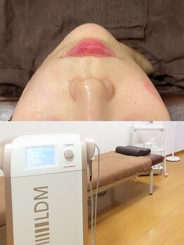 UBメディカルサロンの写真/【話題のオンダリフト導入店♪】小顔効果抜群のマイクロ波を使ったリフトアップ！速効性を感じたい方必見◎