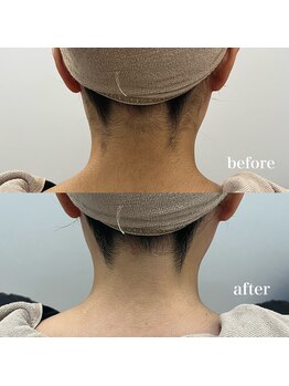 ラクシー 御徒町(luxssy)/うなじシェービング