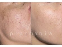 スーン(soon)/プラズマで叶える、理想の素肌へ