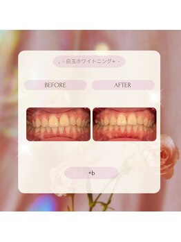 プラスビー 2号店(+b)/ホワイトニングビフォーアフター