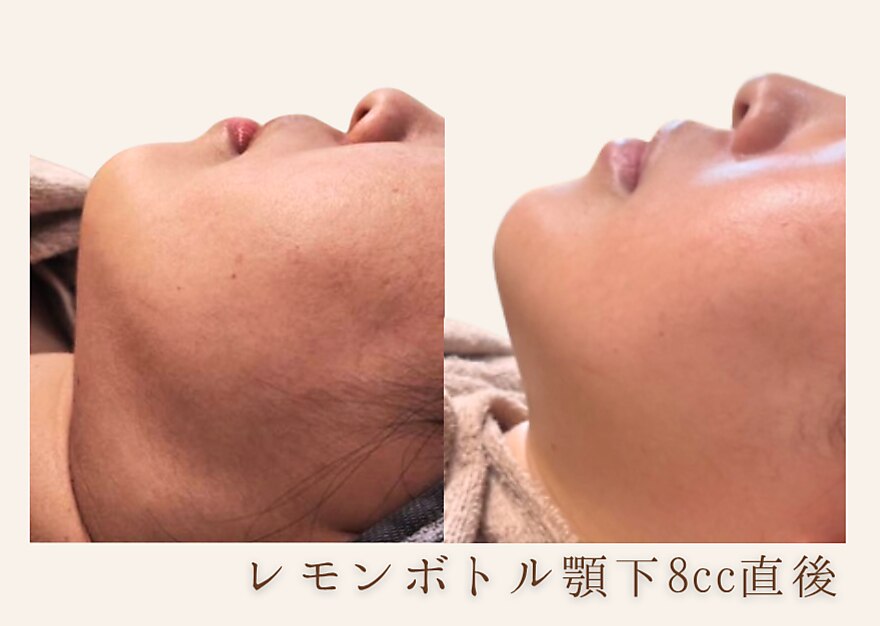 韓国発★速効実感！脂肪分解　【レモンボトル2cc】￥11000→\6600