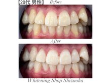 ホワイトニングショップ 静岡店/ホワイトニングBefore→After