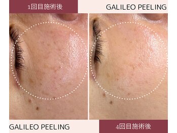 ルームエイトエイティスリー 新宿(R883)/ガリレオピーリングで肌活性