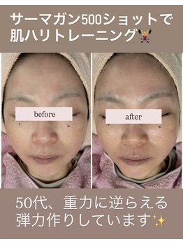 ピュルテ/サーマガンで肌ハリトレーニング