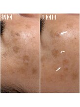 コリー(Kolly)/シミケア1回