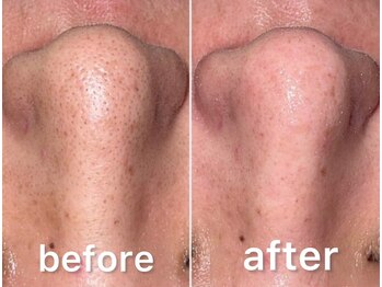 ネムレル森(Nemureru森)/毛穴洗浄【水巻/八幡西区/直方】