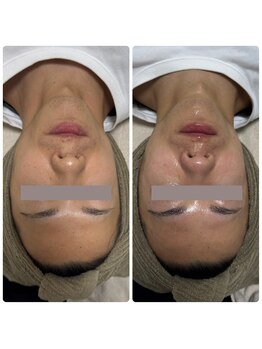 サラン(SALON)/メンズ ビフォーアフター