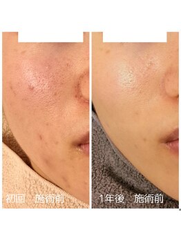 エリン(ERIN)/毛穴徹底洗浄×ピーリング