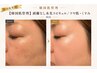 【ツヤ肌/くすみ/毛穴】剥離なし水光スピキュル☆韓国肌管理 90分 ¥15,000