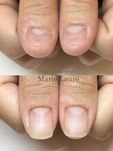 マリーロール 梅田店(Marie Laure)/自爪育成/深爪矯正/ネイルケア