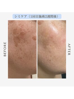 ジール(GIILL)/シミケアビフォーアフター