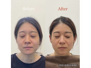 鍼灸チャンドラ(鍼灸Chandra)/女優鍼